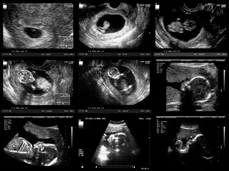 Your baby's ultrasound will look like this over the coming months